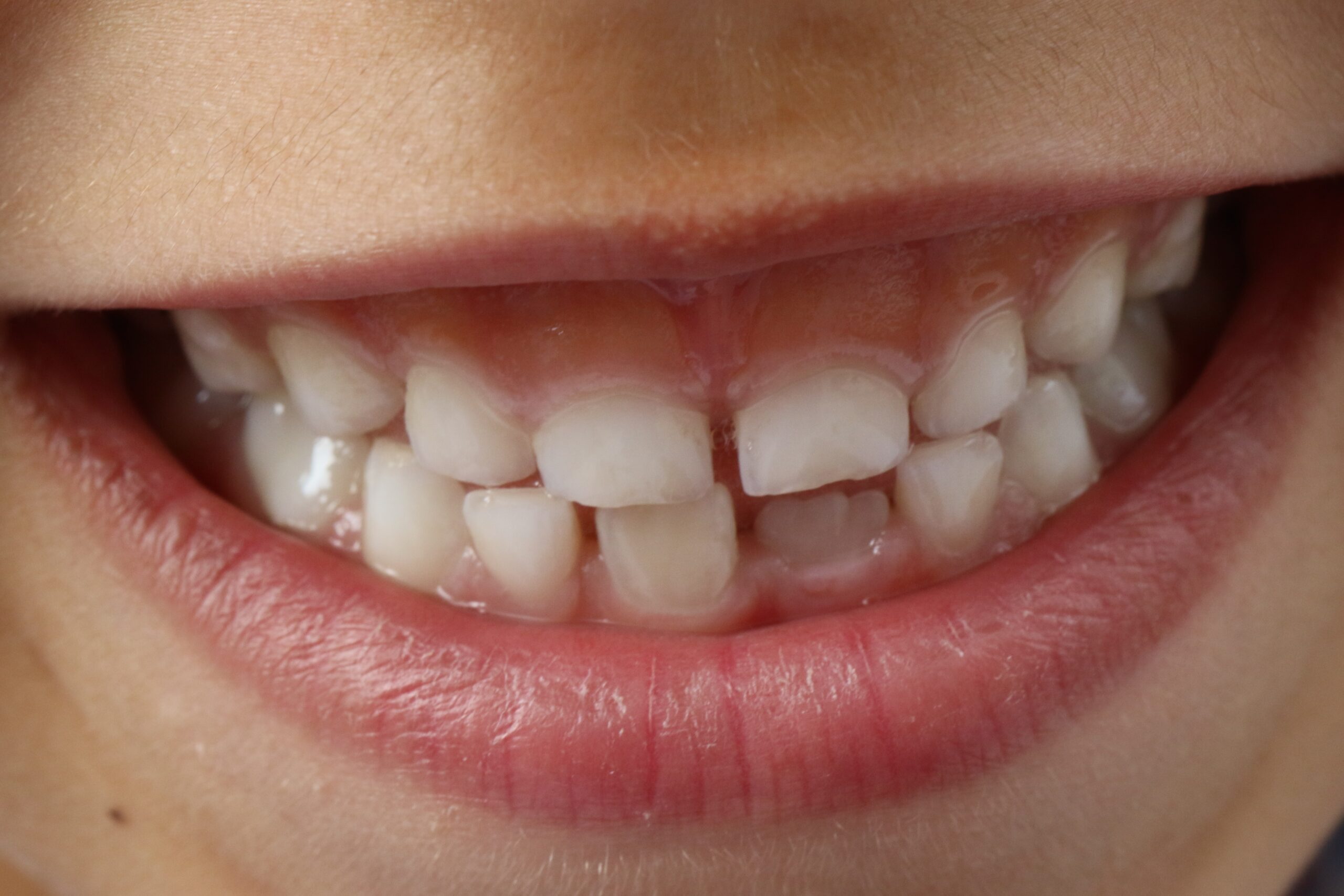 Dentes de leite também precisam de cuidados? Entenda a higiene bucal infantil, as cáries e quando levar a criança ao dentista